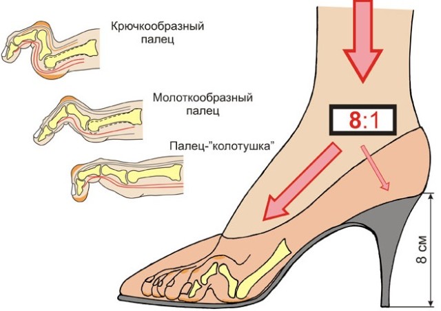 Тесная обувь Тесная обувь