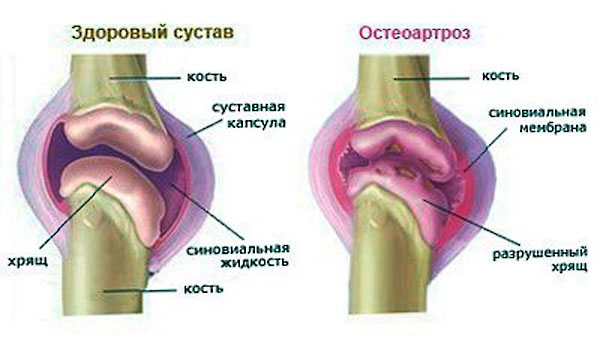 Изменения при остеоартрозе Изменения при остеоартрозе