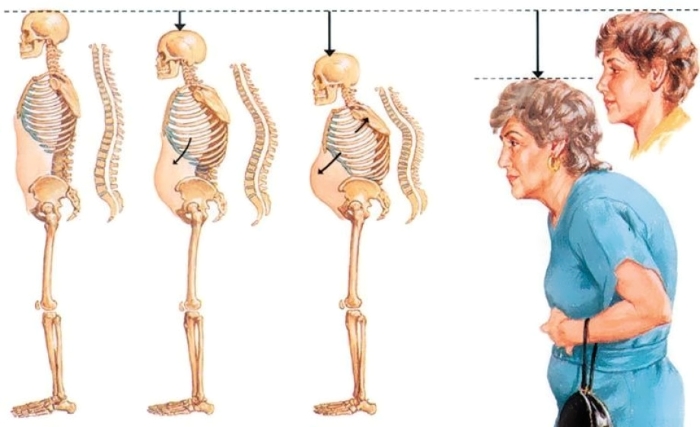 Изменения позвоночника при остеопорозе со временем Изменения позвоночника при остеопорозе со временем
