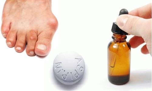 Сочетание йода и аспирина от косточек на ногах Сочетание йода и аспирина от косточек на ногах
