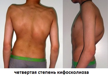 Спина при кифосколиозе 4 степени