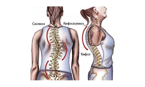 Кифосколиоз позвоночника