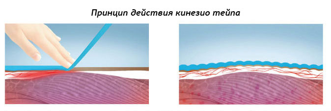 Принцип действия кинезио тейпов