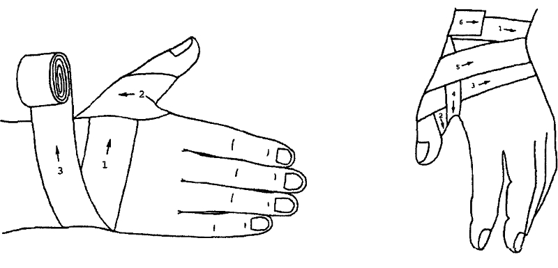 Колосовидная повязка на большой палец руки Колосовидная повязка на большой палец руки