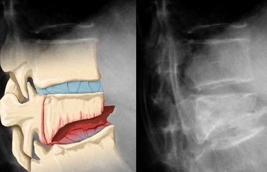 Компрессионный перелом грудного отдела на рентгене Компрессионный перелом грудного отдела на рентгене
