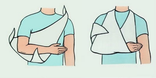 Обездвиживание локтевого сустава при бурсите Обездвиживание локтевого сустава при бурсите