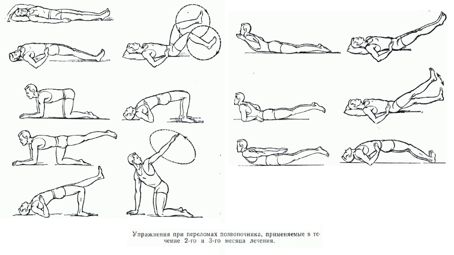 ЛФК при компрессионных переломах позвоночника ЛФК при компрессионных переломах позвоночника