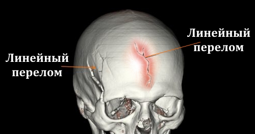 Линейные переломы лобной кости Линейные переломы лобной кости