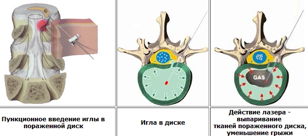 Лазерная вапоризация грыжи позвоночника Лазерная вапоризация грыжи позвоночника