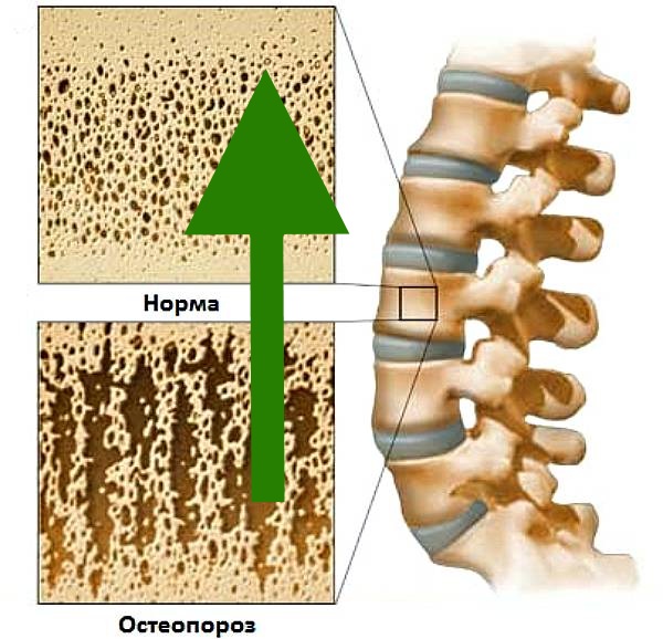 Лечение остеопороза Лечение остеопороза