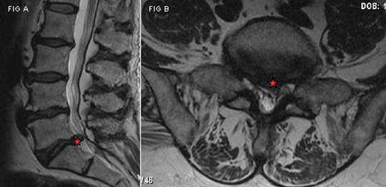МРТ — миелограмма при протрузии МРТ — миелограмма при протрузии