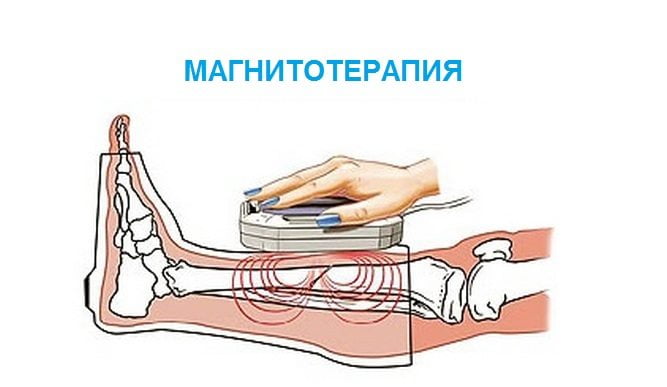 Магнитотерапия голеностопа