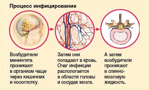 Менингит Менингит