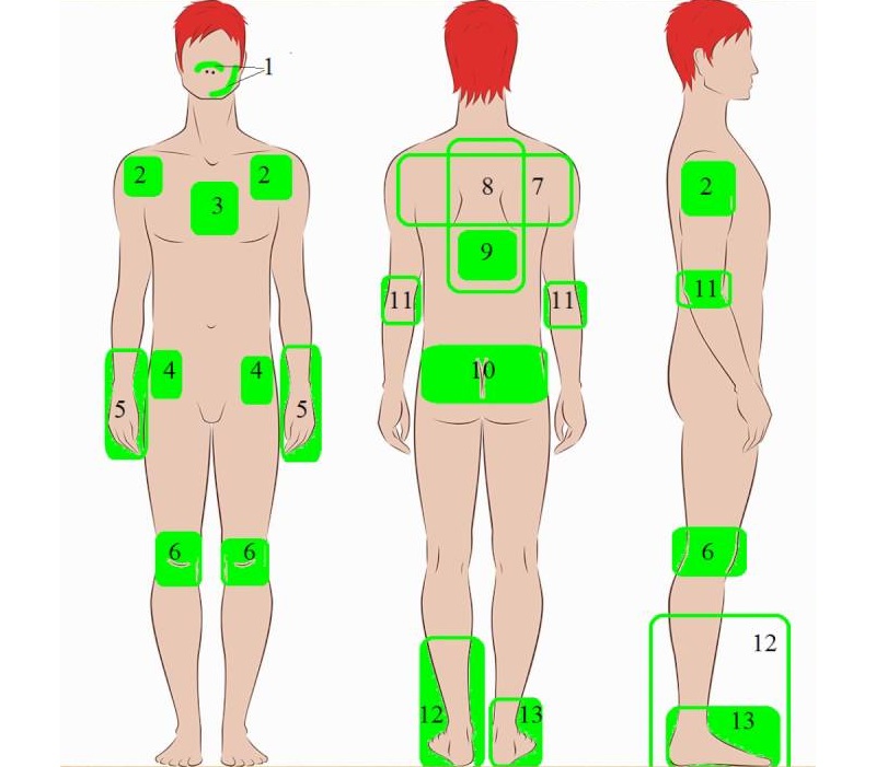 Места наложения озокерита Места наложения озокерита