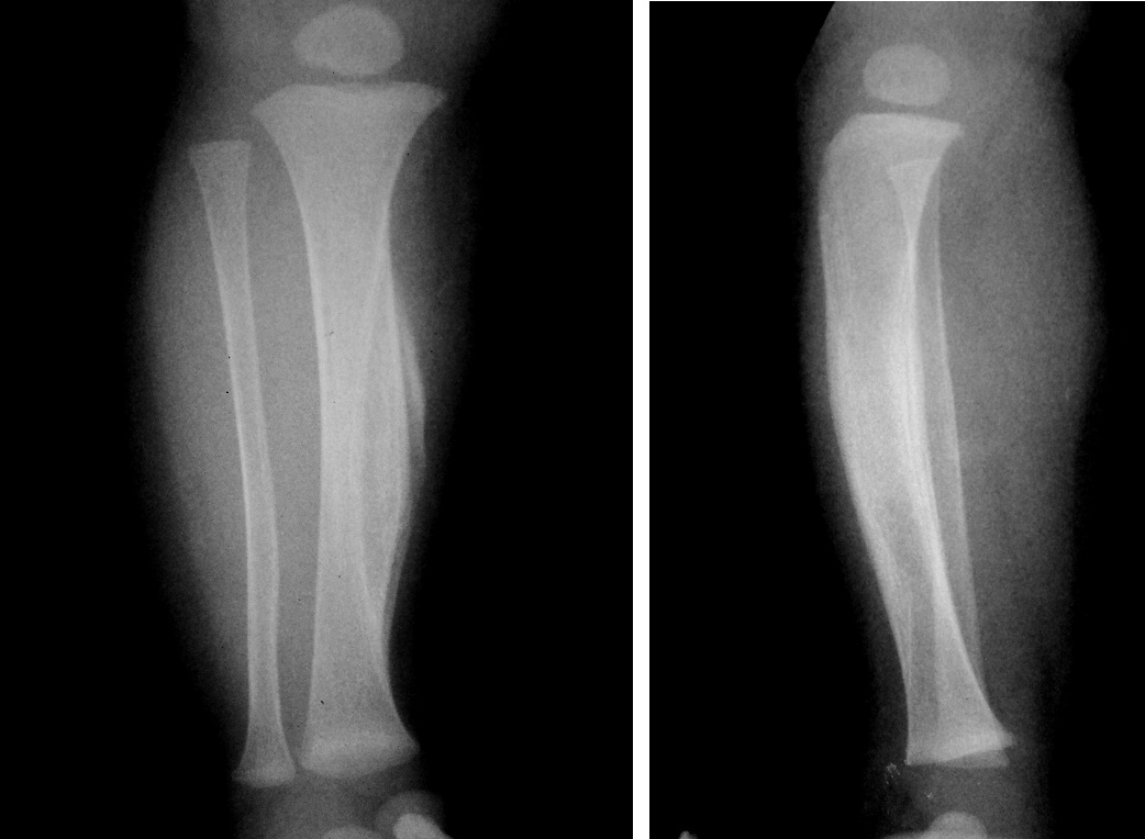 Младенческий кортикальный гиперостоз Младенческий кортикальный гиперостоз