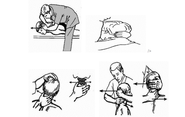 Мобилизация и иммобилизация (замыкание) шейного отдела позвоночника с помощью бокового наклона Мобилизация и иммобилизация (замыкание) шейного отдела позвоночника с помощью бокового наклона