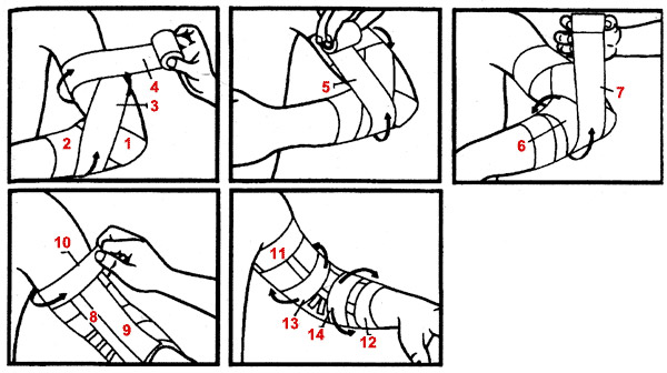 Этапы наложения черепашьей повязки на локоть Этапы наложения черепашьей повязки на локоть