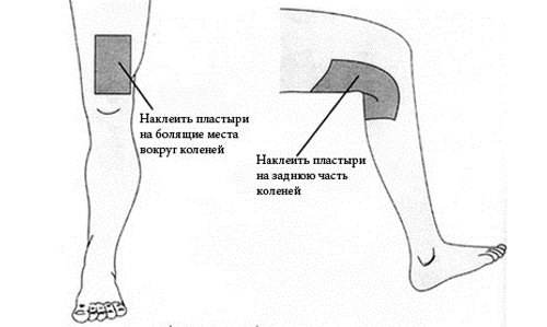 Наложение горчичников на коленный сустав Наложение горчичников на коленный сустав