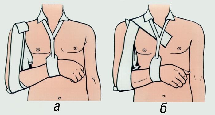 Наложение повязки при вывихе ключицы Наложение повязки при вывихе ключицы