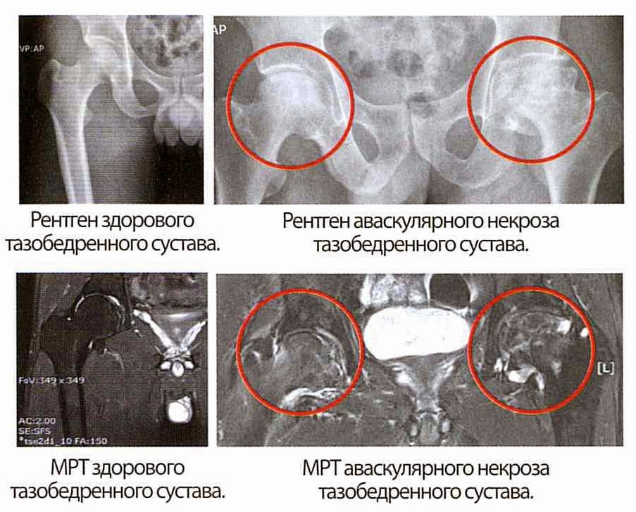 Некроз тазобедренного сустава на рентген снимке Некроз тазобедренного сустава на рентген снимке