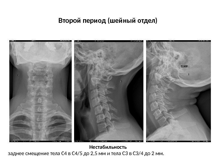 Нестабильность позвонков шейного отдела на рентгене Нестабильность позвонков шейного отдела на рентгене