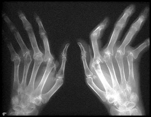 Олигоартрит на рентген снимке Олигоартрит на рентген снимке