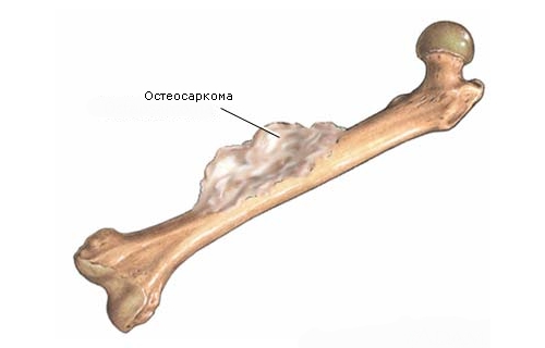 Опухоль кости Опухоль кости