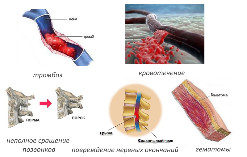 Частые осложнения после спондилодеза Частые осложнения после спондилодеза