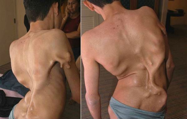 Тяжелый оссифицирующий миозит Тяжелый оссифицирующий миозит