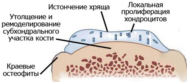 Остеоартроз Остеоартроз