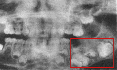 Остеобластокластома после удаления зуба Остеобластокластома после удаления зуба