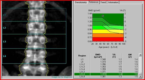 Остеоденситометрия позвоночника Остеоденситометрия позвоночника
