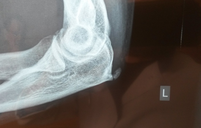 Остеофиты на рентгене Остеофиты на рентгене