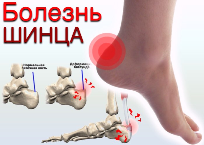 Болезнь Шинца