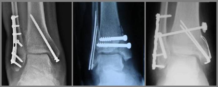 Остеометаллосинтез при переломах лодыжек Остеометаллосинтез при переломах лодыжек