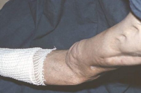 Деформация кости при остеомиелите Деформация кости при остеомиелите