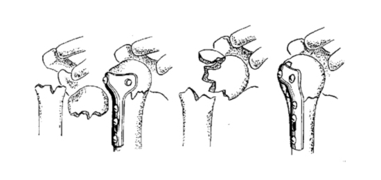 Остеосинтез переломов проксимального отдела плеча пластиной Остеосинтез переломов проксимального отдела плеча пластиной