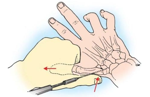 Остеосинтез спицами при переломовывихе Беннета Остеосинтез спицами при переломовывихе Беннета