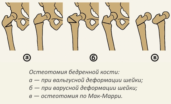 Остеотомия тазобедренной области Остеотомия тазобедренной области