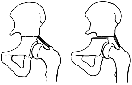 Остеотомия тазовых костей Остеотомия тазовых костей
