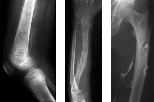 Рентген диагностика остеомиелита Рентген диагностика остеомиелита