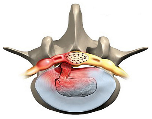 Передавливание нерва при грыже Шморля Передавливание нерва при грыже Шморля