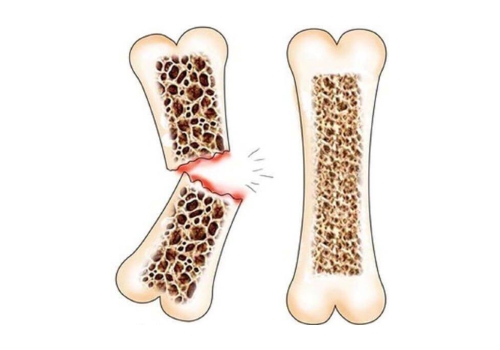 Опасность перелома кости при остеопорозе Опасность перелома кости при остеопорозе