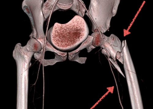 Перелом левой бедренной кости на КТ Перелом левой бедренной кости на КТ