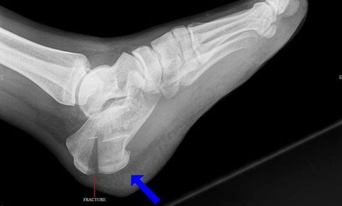 Перелом пяточной кости на рентген снимке Перелом пяточной кости на рентген снимке