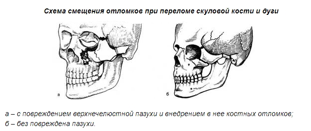 Переломы скуловой кости и дуги Переломы скуловой кости и дуги