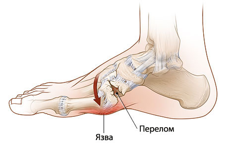 Перелом свода стопы Перелом свода стопы