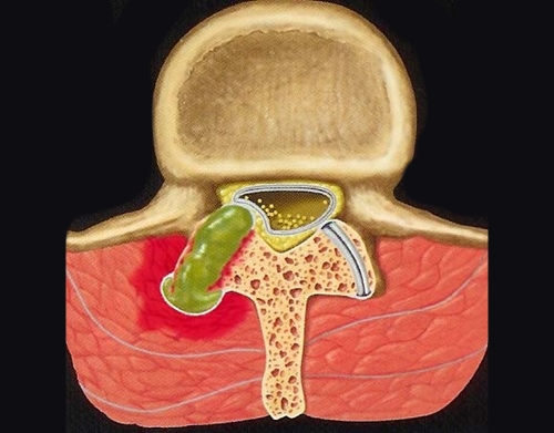 Периартикулярная киста позвоночника Периартикулярная киста позвоночника