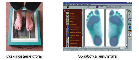 Плантография плоскостопия Плантография плоскостопия