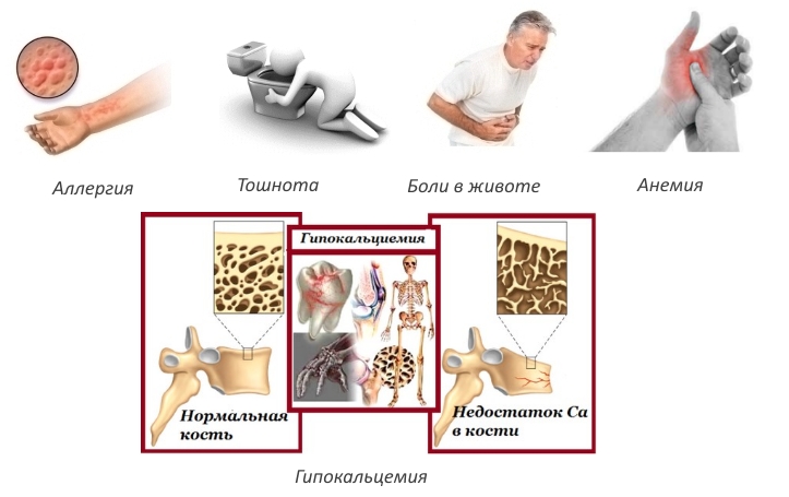 Побочные эффекты Кальцитрина Побочные эффекты Кальцитрина